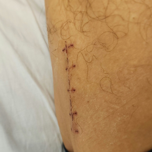 手術痕（抜糸済み） | Flickr