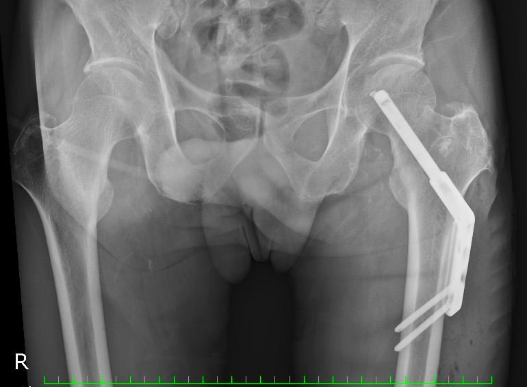 手術後（2025-12-04） | Flickr